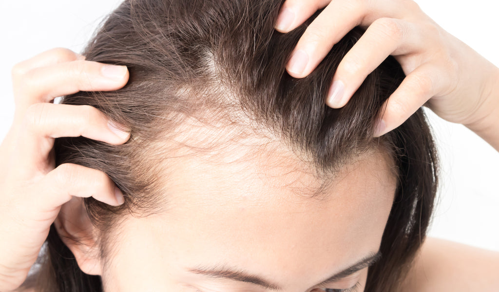 alopecia, hair loss, hair fall