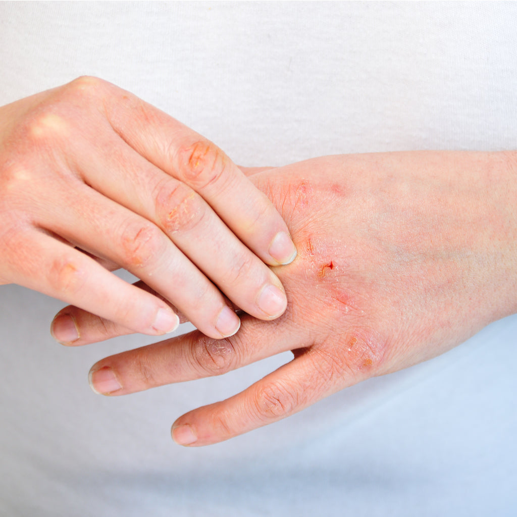 Prevent Dry Hands with the Right Skin Care Routine